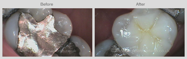 Invisalign Clear Braces in Stevenage - Stevenage Dental Studio